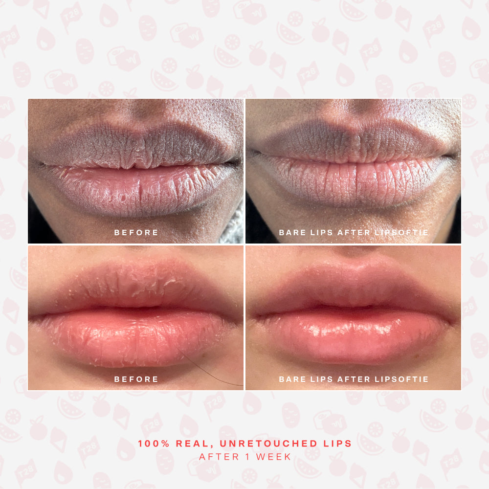 SOS LipSoftie® Lip Treatment J0