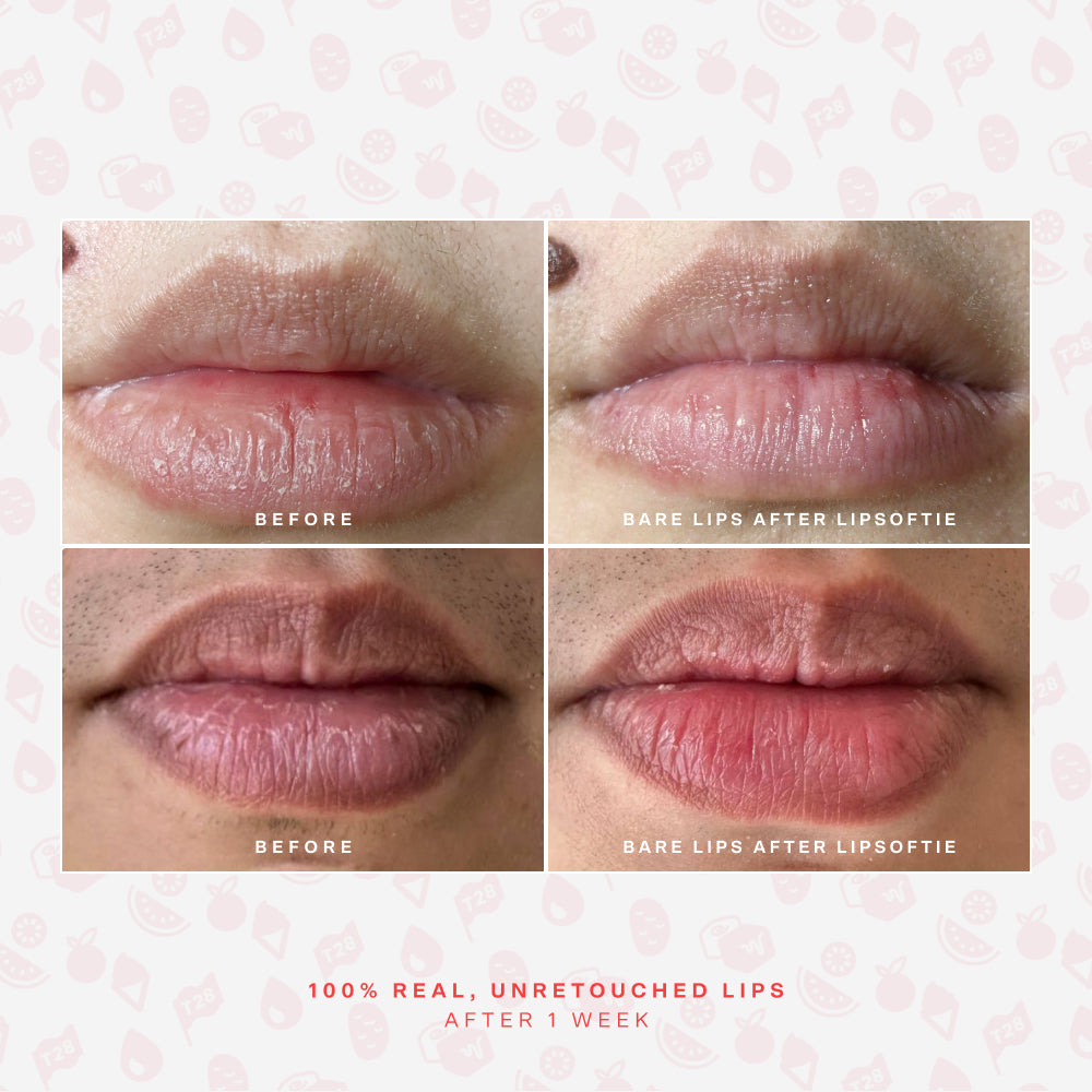 SOS LipSoftie® Lip Treatment J0