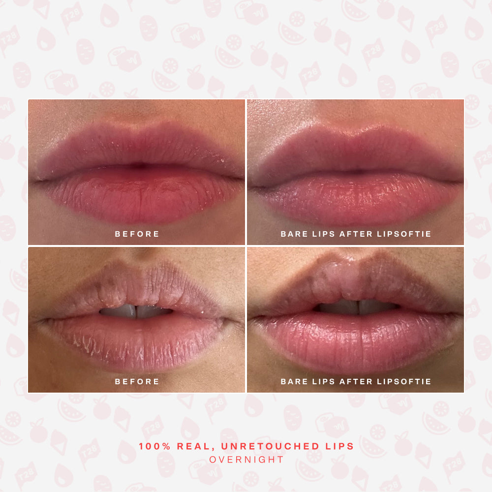 SOS LipSoftie® Lip Treatment J0